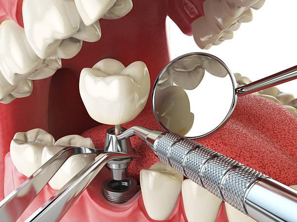 Best Emergency Dental Extractions in Munday, TX